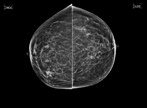 Mamografická snímka prsníka