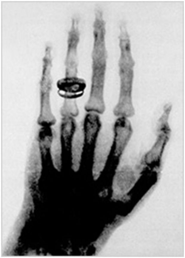 RTG snímka ruky W.C. Röntgena