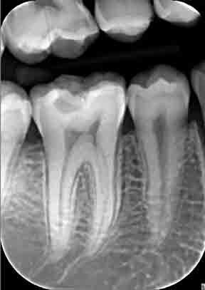 Intraorálna snímka zubov